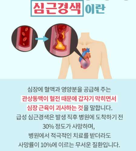심근경색 전조증상 및 원인&#44; 치료법