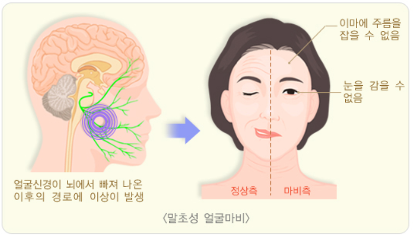 말초성 얼굴마비 사진