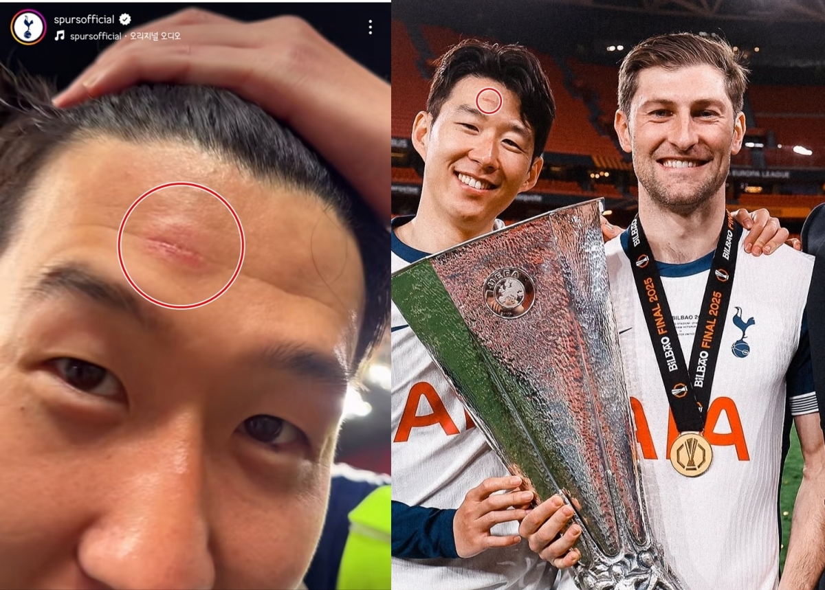 손흥민 ❘ 이마 상처