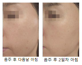 음주후 다음날, 2일 후 기미 변화