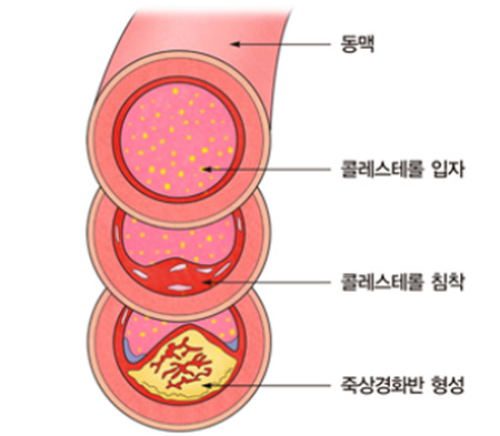 콜레스테롤_증상