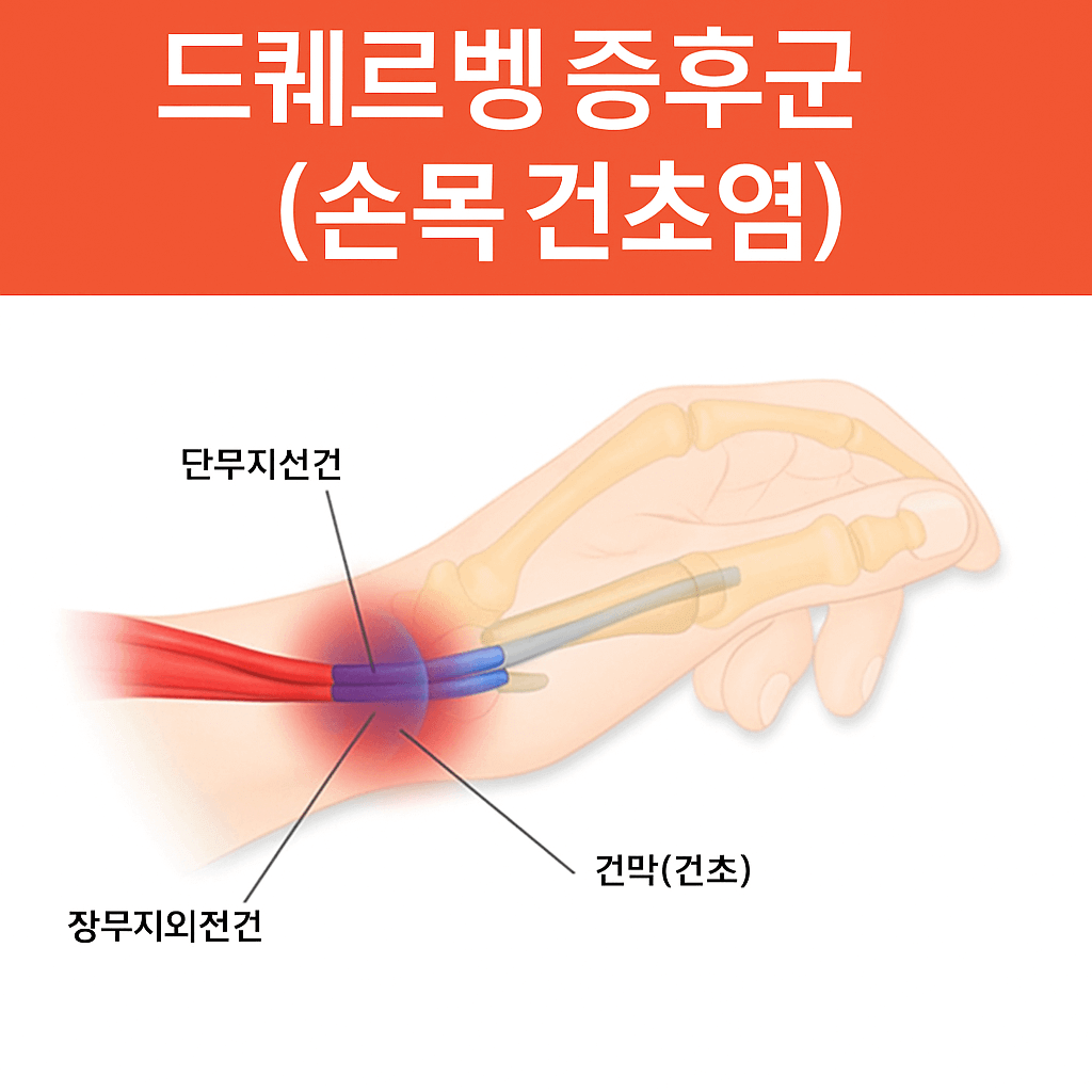 드퀘르벵 증후군 총정리