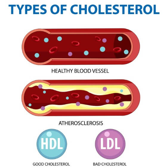 혈관에 노폐물이 끼어 있는 모습