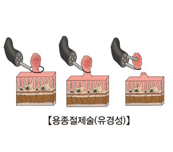 용종과 선종의 차이