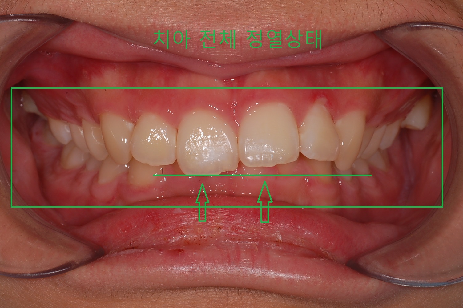 부정교합 가위교합 과개교합 치아교정 후기2