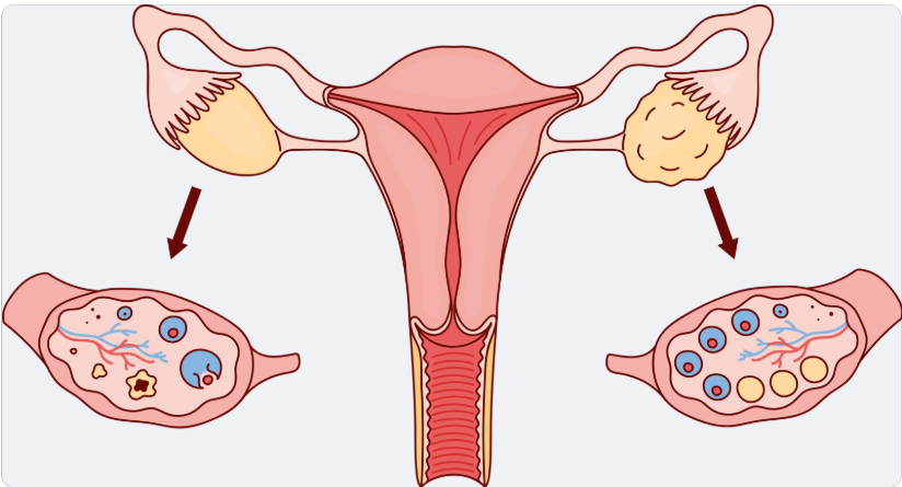 다낭성 난소 증후군 무월경 여드름 비만