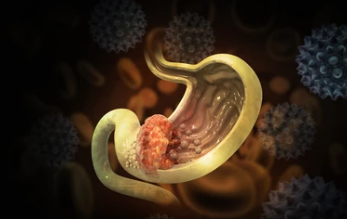 위암 4기 생존율