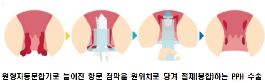PPH 수술(원형문합기 치핵고정술)을 도식화한 이미지로 총 4가지의 그림이 나열되어 있습니다.