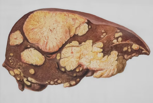 췌장염과 췌장암, 어떻게 구분할까(췌장암, 감별진단, 고위험군)의 이미지