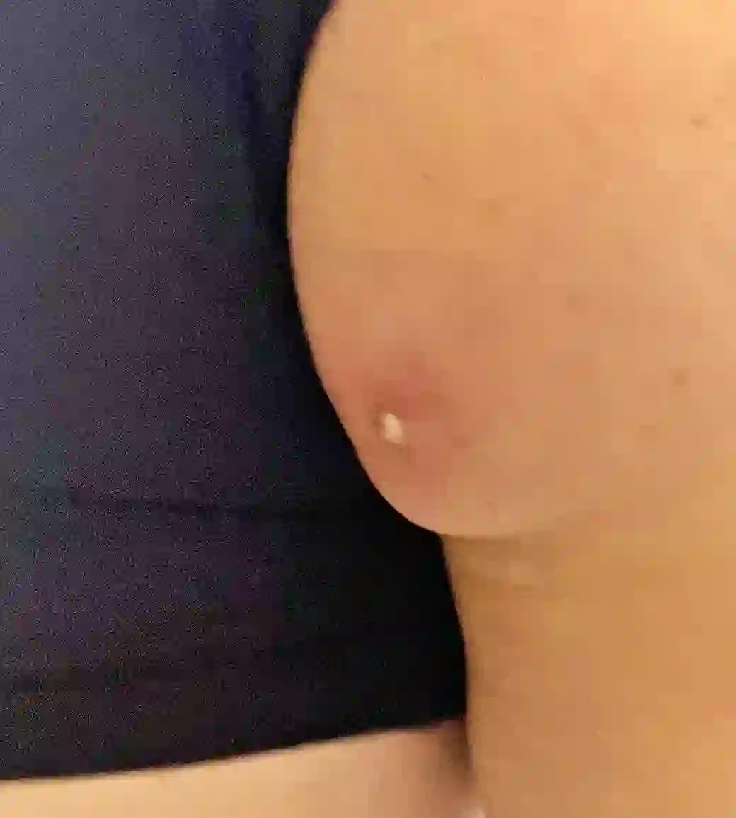 엉덩이 종기 사진, 엉덩이에 발생 후 내 엉덩이 촬영