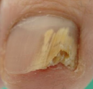 발톱무좀 없애는 방법 6