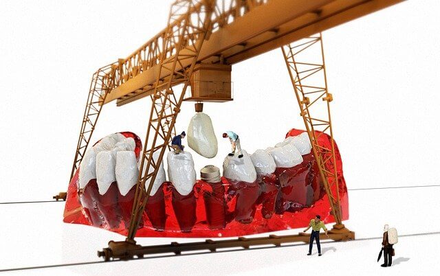 임플란트 시술 컨셉 이미지