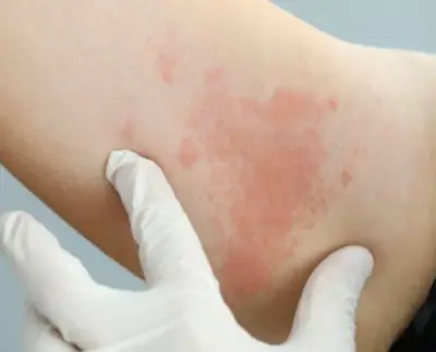 대상포진-예방접종-무료-가격-종류-건강