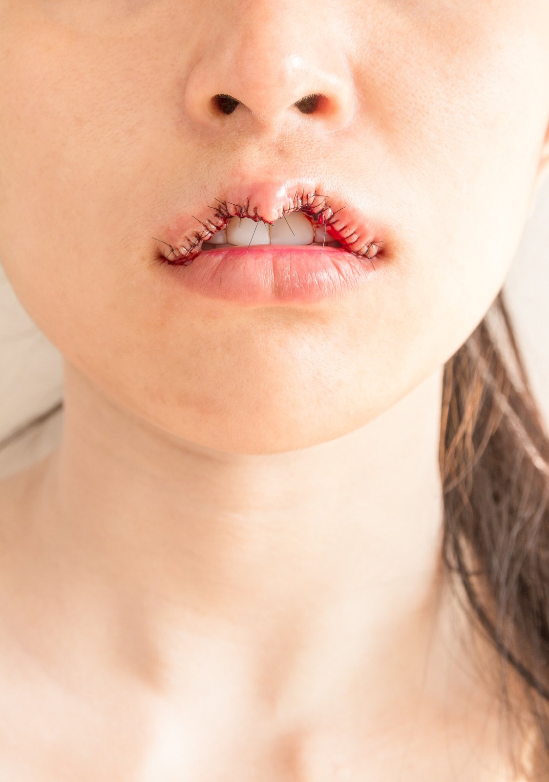 인중 축소 시술: 더 짧고 균형 잡힌 얼굴을 위한 시술