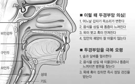 비인두암 예후와 EBV DNA 수준