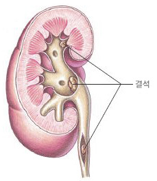 요로결석 증상&middot;원인&middot;치료 -극심한 통증의 원인