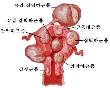 자궁근종