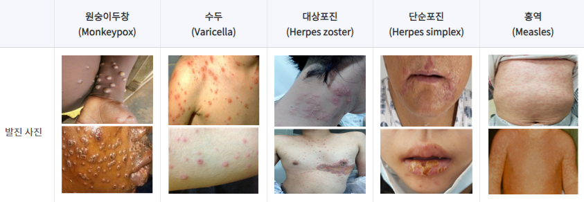 원숭이두창증상