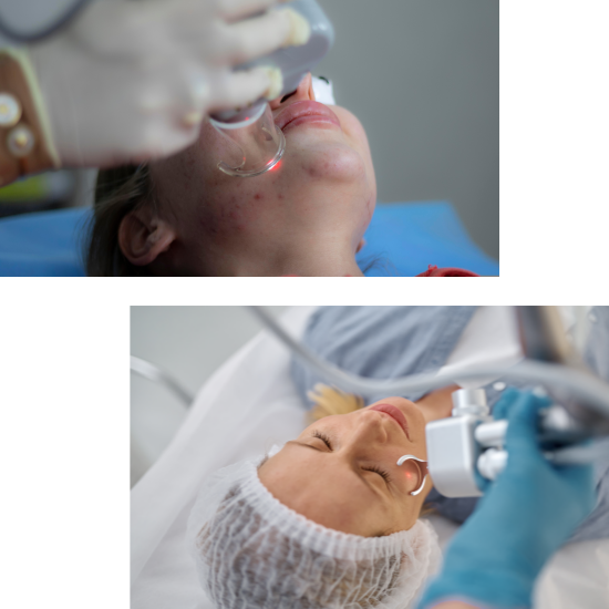 피지샘증식증의 치료법