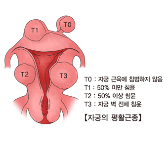자궁 평활근종 출처 서울 아산 병원 홈페이지