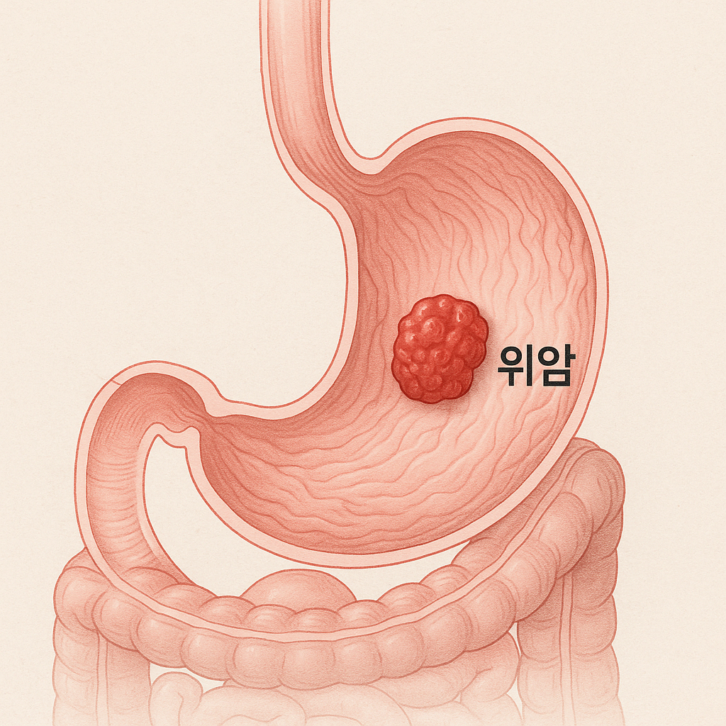 위암 초기증상