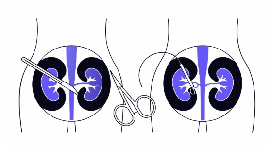 요로결석 수술과정