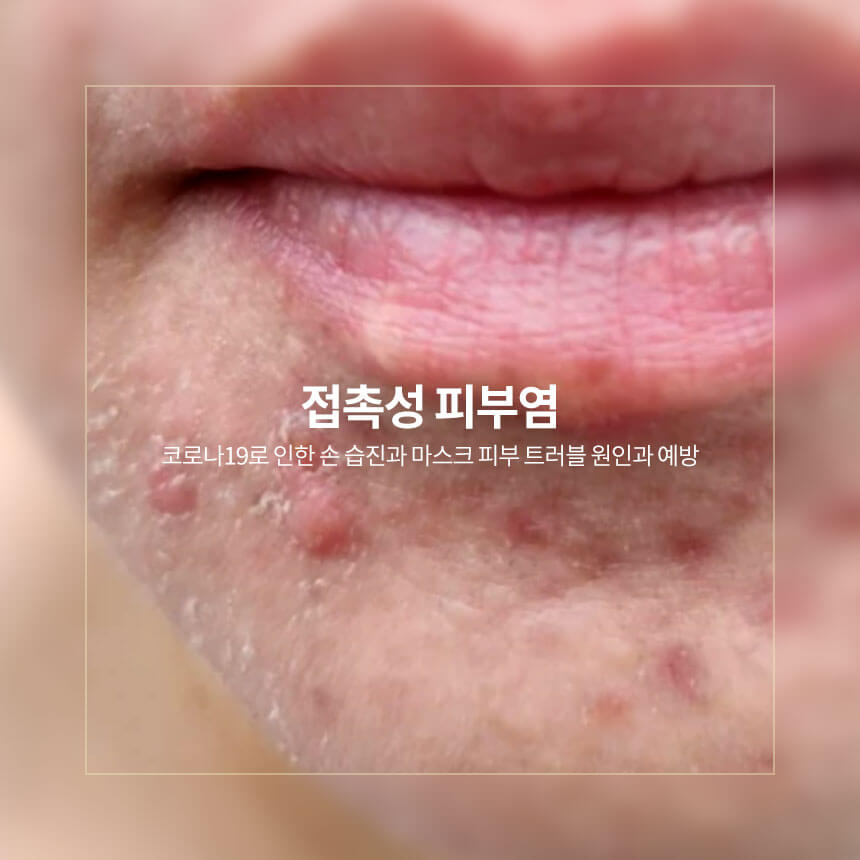 “접촉성-피부염과-마스크-피부-트러블”