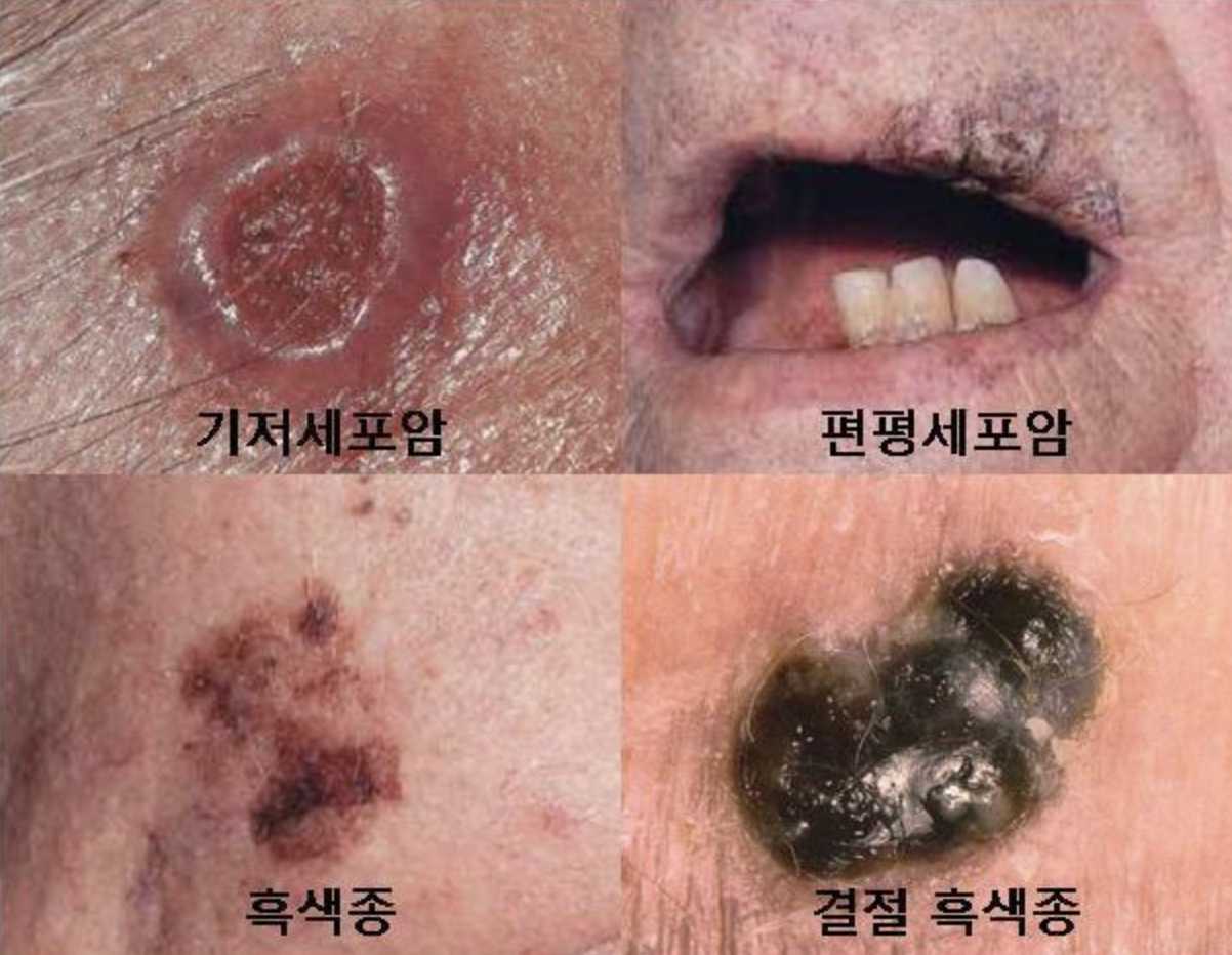 피부암 증상