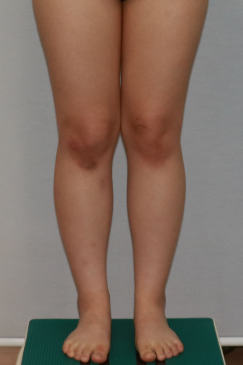 하체지방흡입 가격