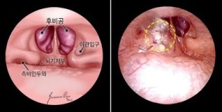 발병 원인과 고위험군