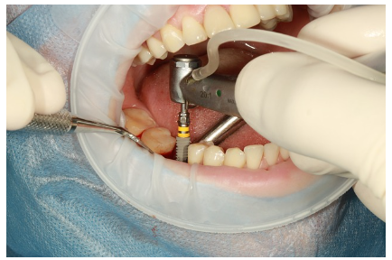 2023년 임플란트 가격