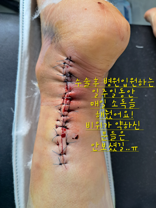 아킬레스건 완전 파열 후기2-병원 입원후 수술까지 과정과 비용