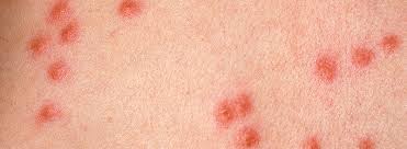 지루성 피부염 완치하려면