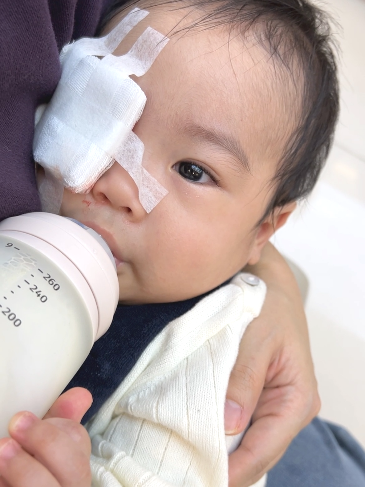 아기 다래끼 시술 직후 모습 - 절개 치료 후 붓기와 회복 초기 상태