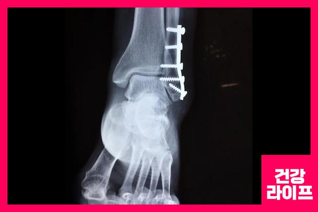 발목 골절로 인한 발목 통증