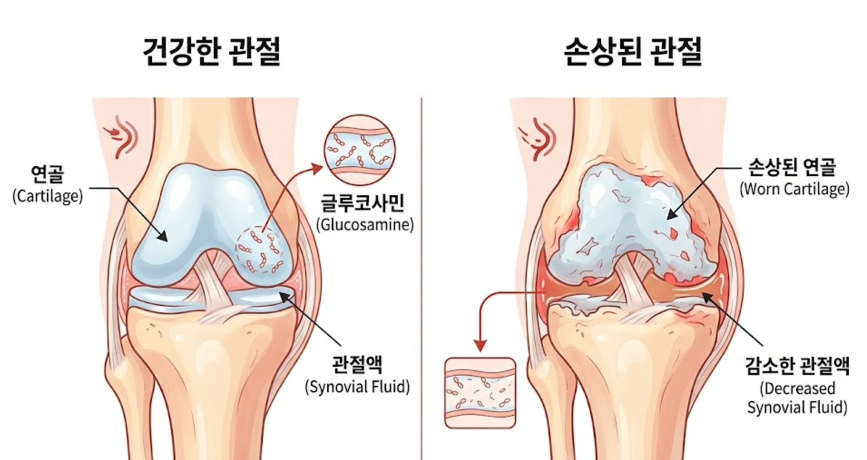연골의 구조와 글루코사민 역할
