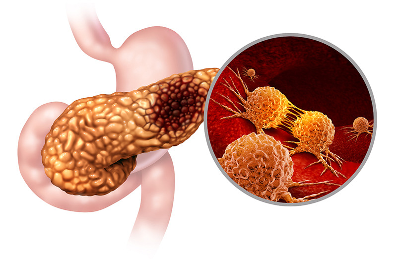 췌장암 검사방법