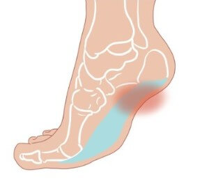 발 디딜때 뒷꿈치 통증