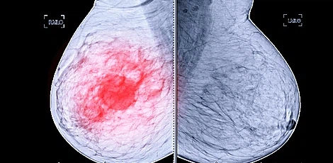 유방암 초기증상