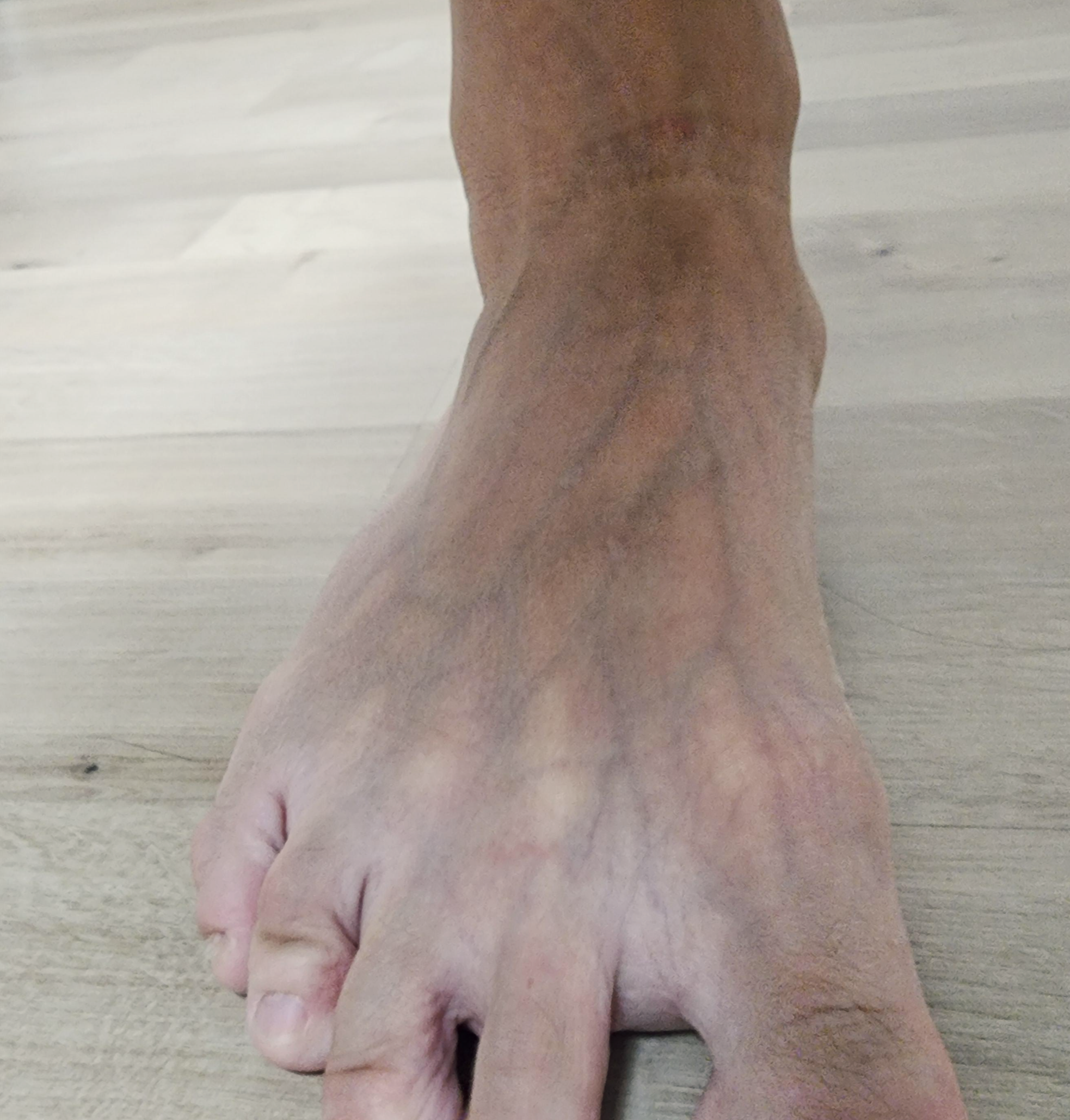 부주상골증후군 발통증