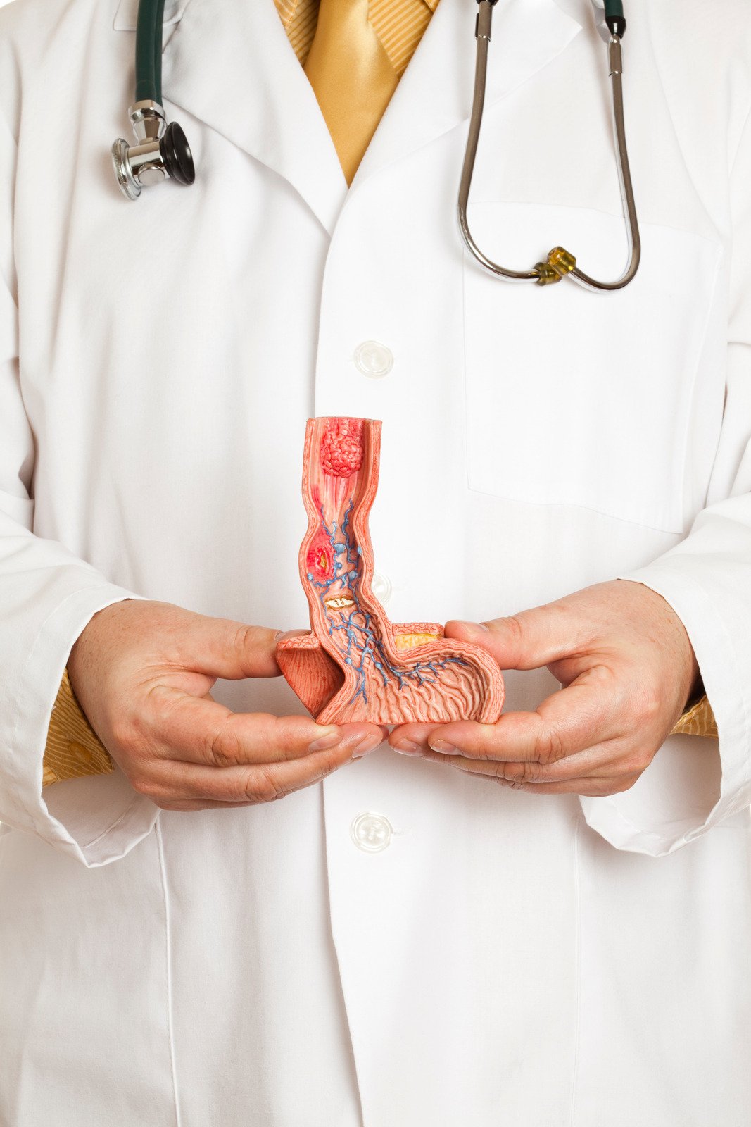 바렛 식도(Barrett's Esophagus): 식도암으로 진행될 수 있는 위험 상태