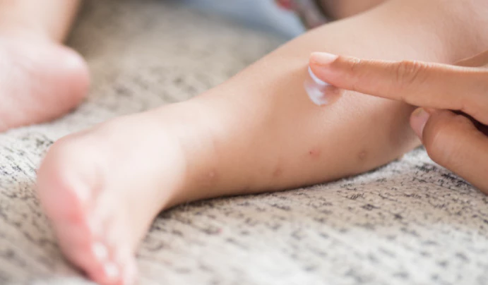 대상포진-초기증상-건강