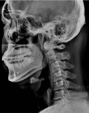 거북목-증후군-만성-목통증-원인