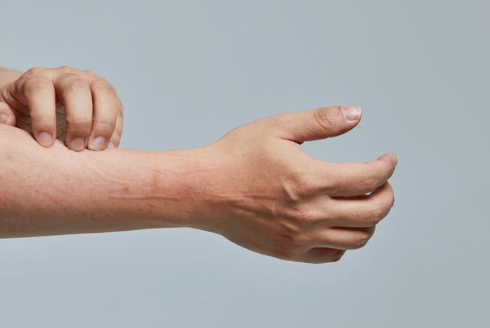 알레르기성 두드러기의 원인과 치료법