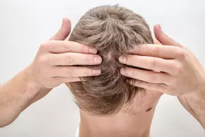 두피 지루성 피부염 증상