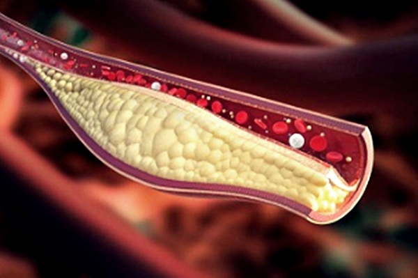 콜레스테롤이 쌓인 혈관