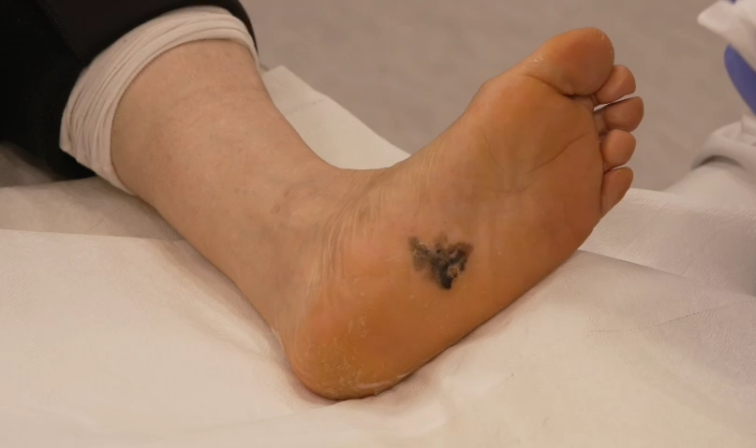 명의 피부암 점 구별법