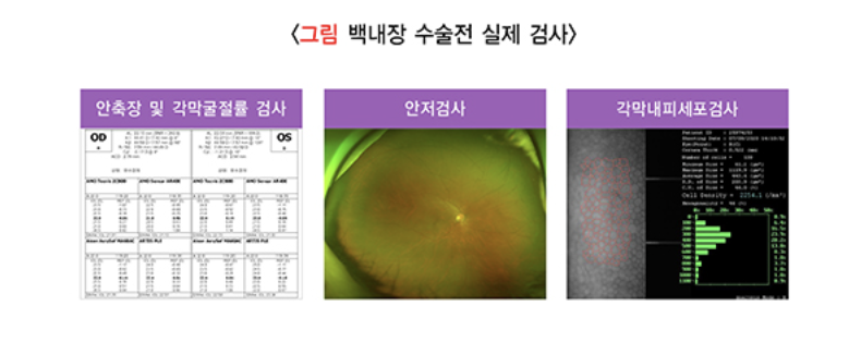 백내장 수술전 검사