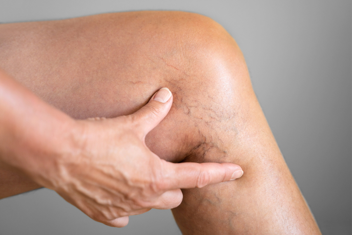 보스웰리아 효능