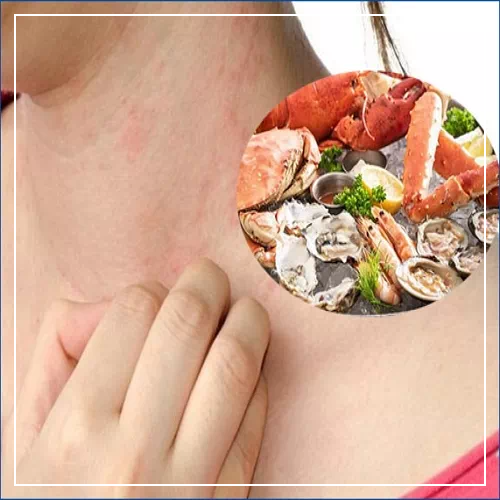 갑각류 알레르기 증상 두드러기